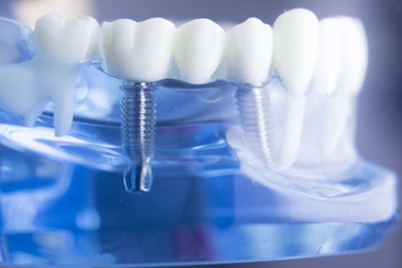 implantologie-zahnarzt-garmisch-scheuber-maier